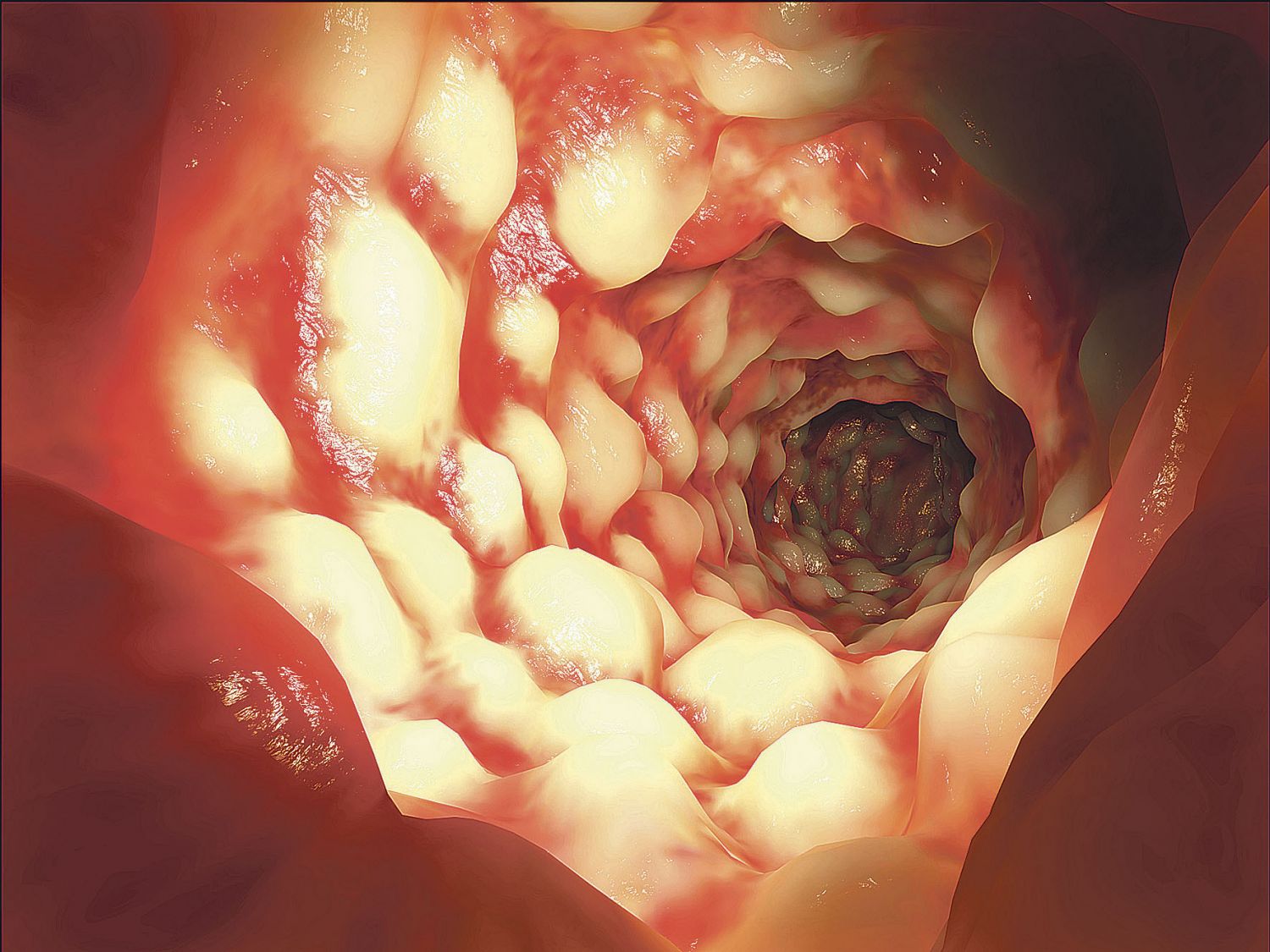  Grafik: Innenraum vom Darm. Thema: Morbus Crohn Therapie